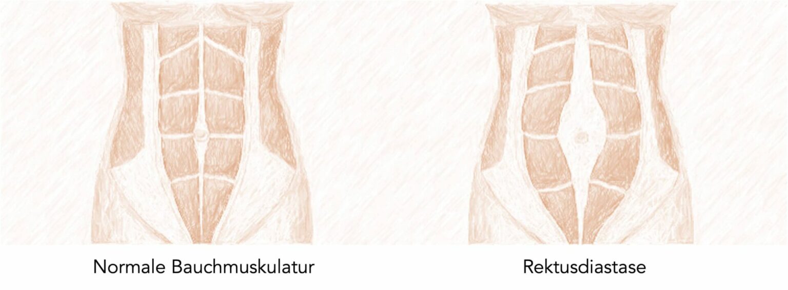 Rektusdiastase Bauchmuskulatur Rectus abdominis Linea Alba FIT MIT BABY rektusdiastase-bauchmuskulatur-rectus-abdominis-linea-alba-fit-mit-baby